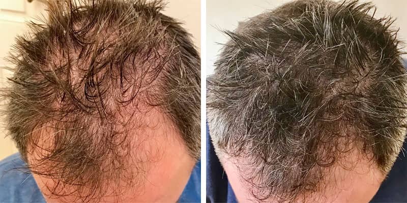 Before and after men&rsquo;s hair loss