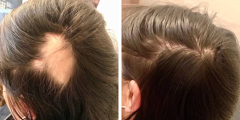 Before and after women&rsquo;s hair loss