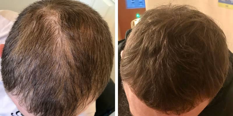 Before and after men&rsquo;s hair loss