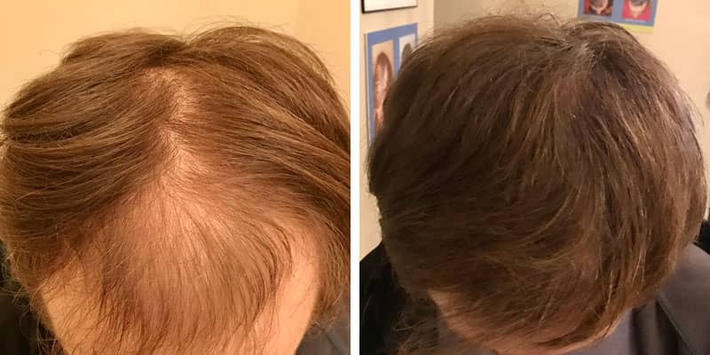 Before and after men’s hair loss