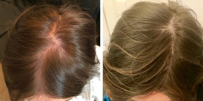 Before and after women&rsquo;s hair loss