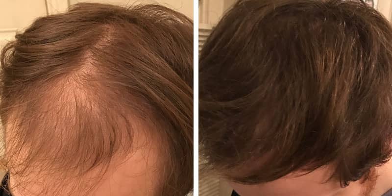 Before and after men’s hair loss