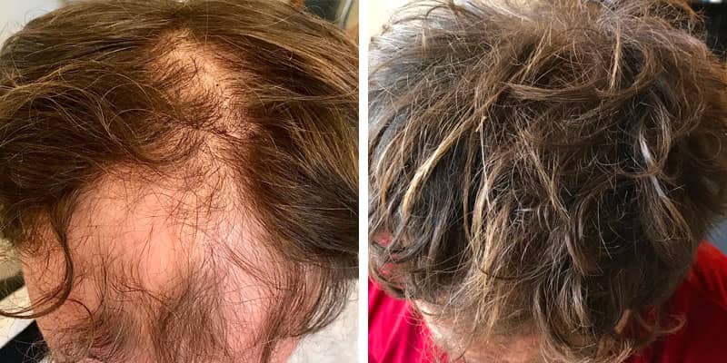 Before and after men&rsquo;s hair loss