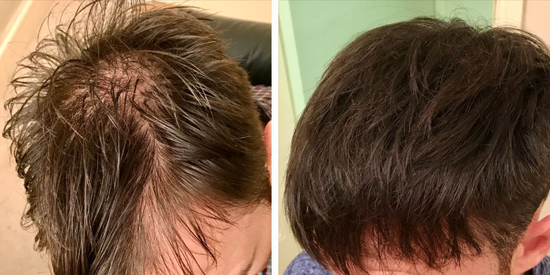 Before and after men&rsquo;s hair loss