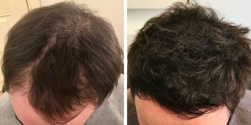 Before and after men&rsquo;s hair loss