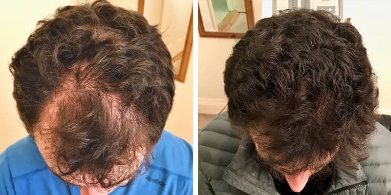 Before and after men&rsquo;s hair loss