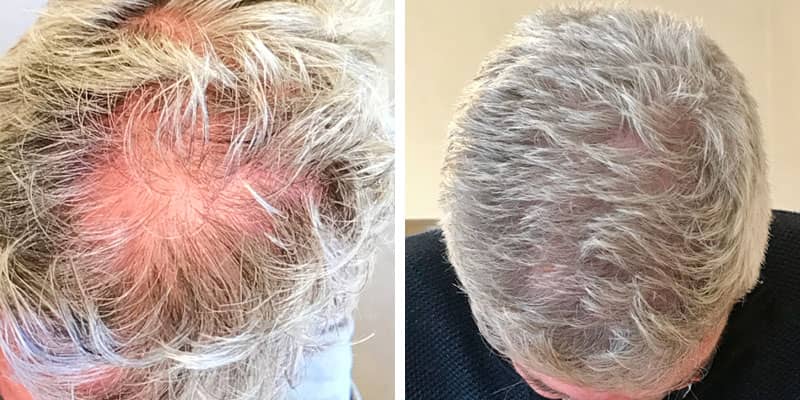 Before and after men&rsquo;s hair loss