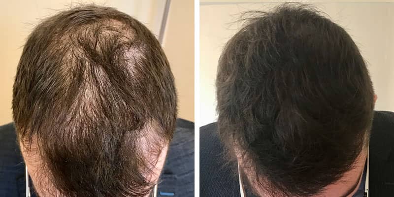 Before and after men&rsquo;s hair loss