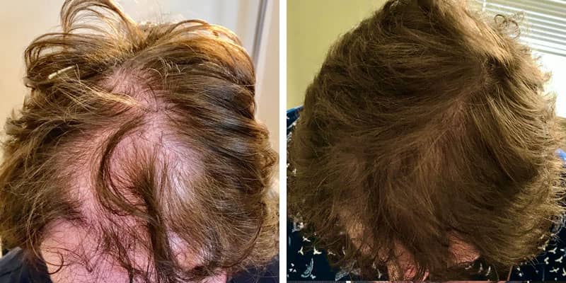 Before and after women&rsquo;s hair loss