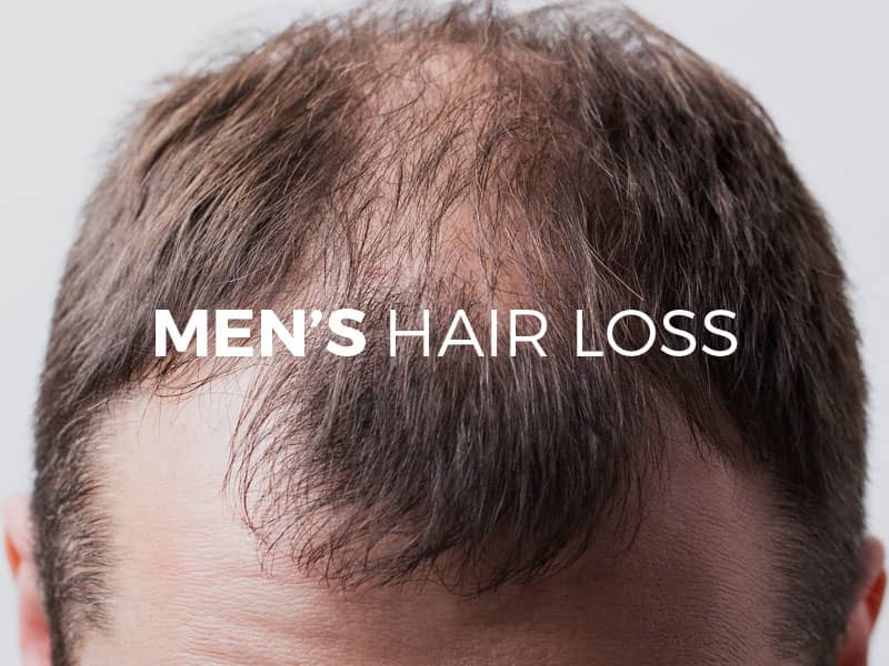 Men&rsquo; Hair Loss