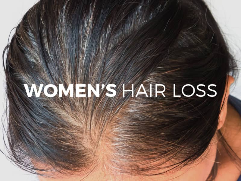 Women&rsquo;s Hair Loss